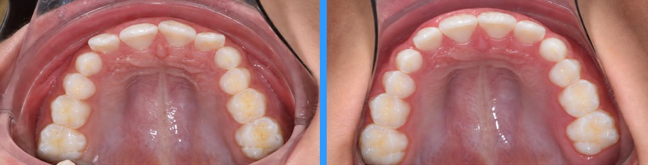 Caso clínico de ortodoncia: antes y después, vista oclusal superior