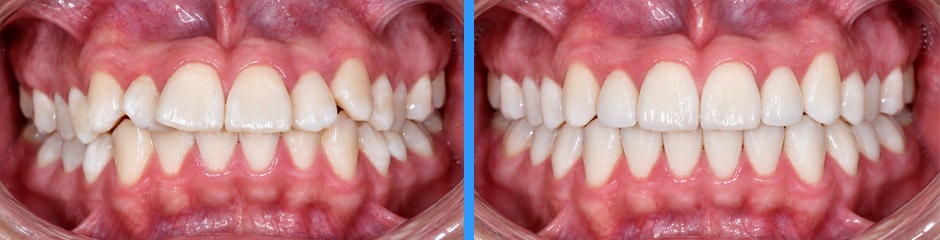Caso clínico de diseño de sonrisa: antes y después
