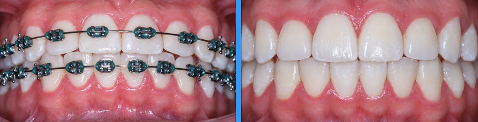 Caso clínico: tratamiento con brackets, antes y después