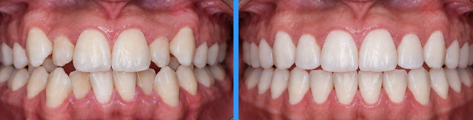 Caso clínico: cierre de espacios y alineación dental, antes y después